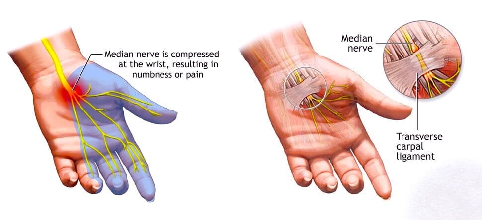 Carpal Tunnel Syndrome Shockwave Treatment.