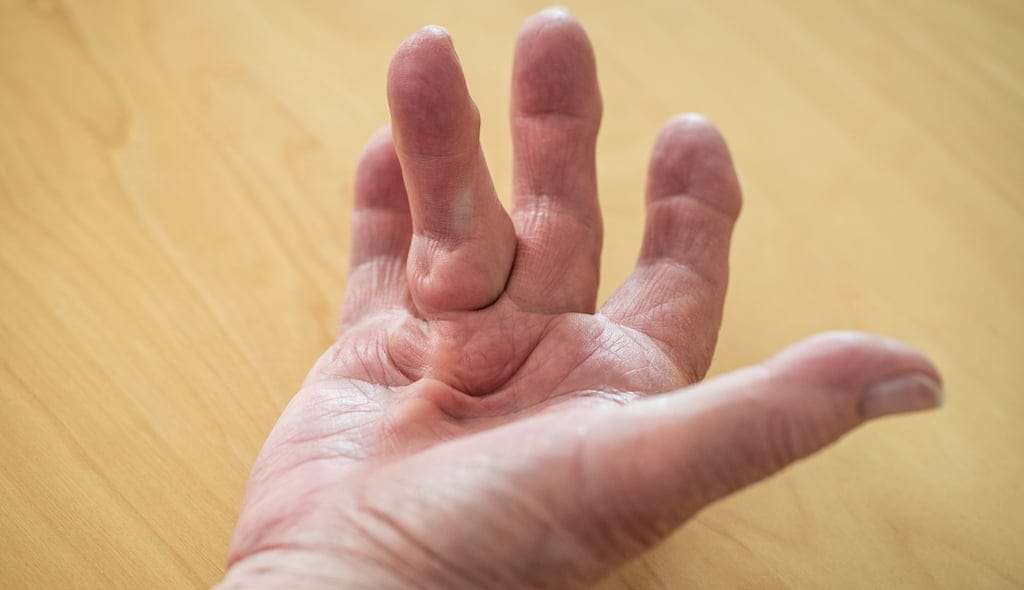 Dupuytren’s Disease Shockwave Treatment.