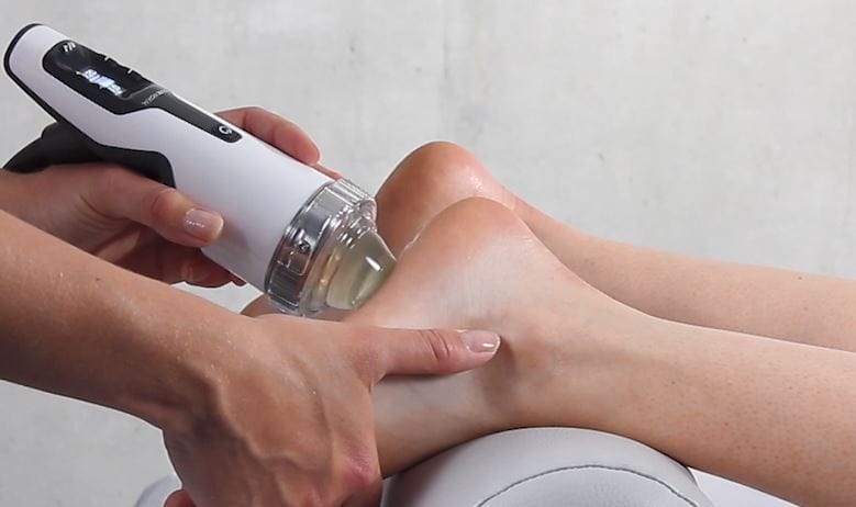 plantar fasciitis shockwave treatment.