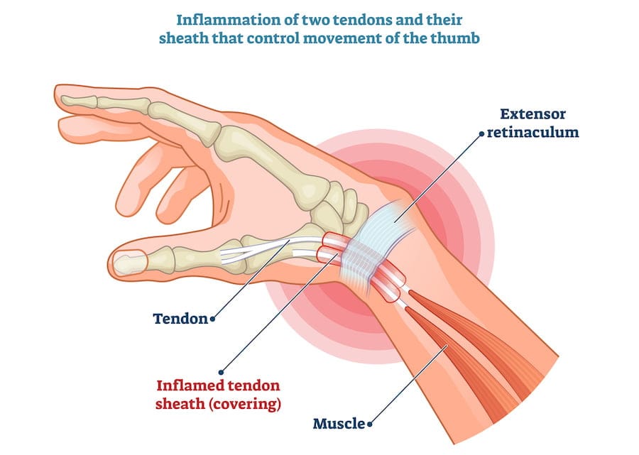 De Quervain’s Syndrome Shockwave.