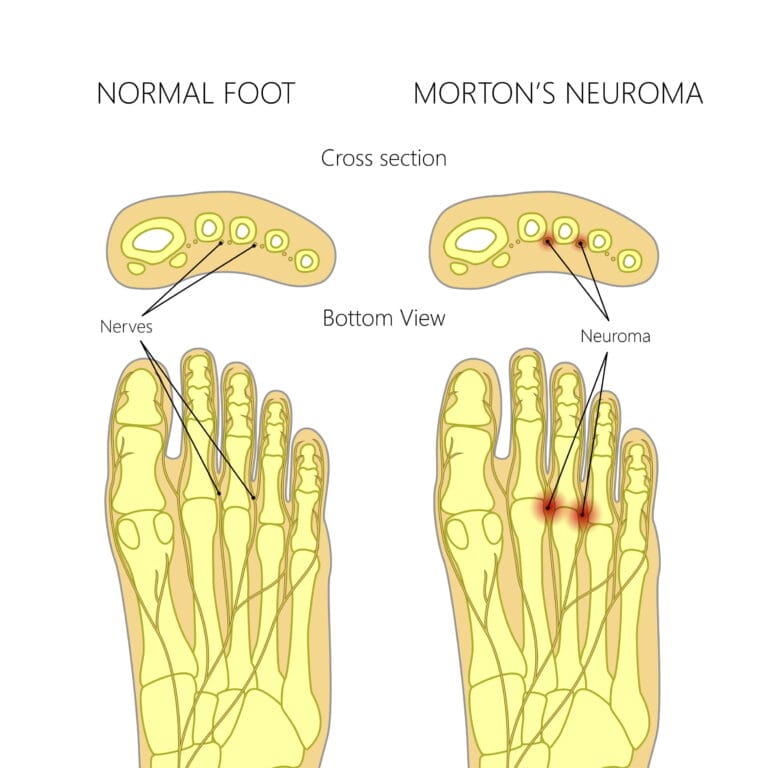 Morton's Neuroma Shockwave Treatment.